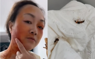 河南河北山东不少人被隐翅虫的毒液所伤